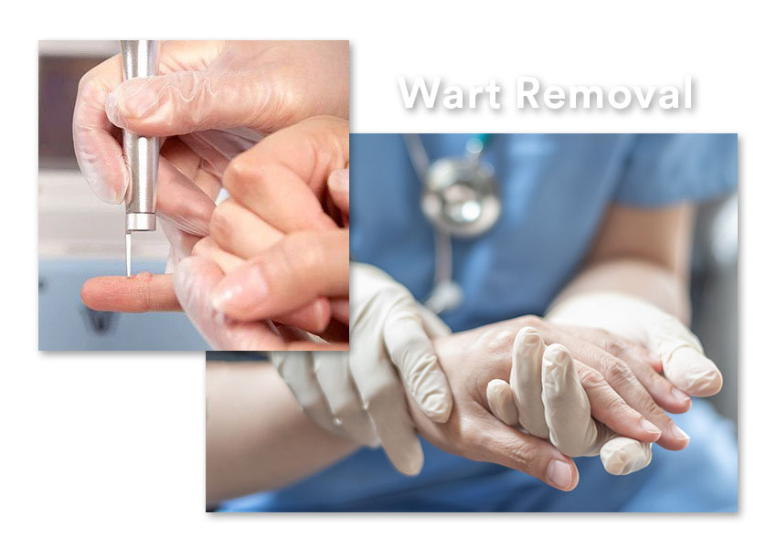Wart Removal in Chennai | wart removal clinic in chennai || Dr. Lavanya  Skin & Hair Clinic
